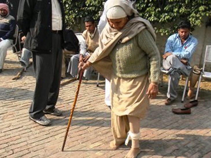 Artificial Limb beneficiary